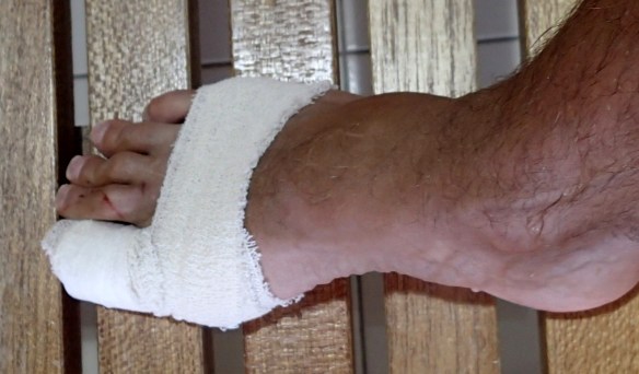 My Injured Foot